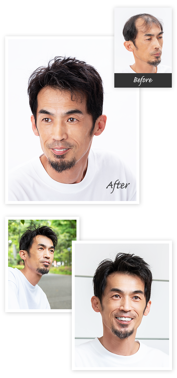 Aderans 假发 案例1