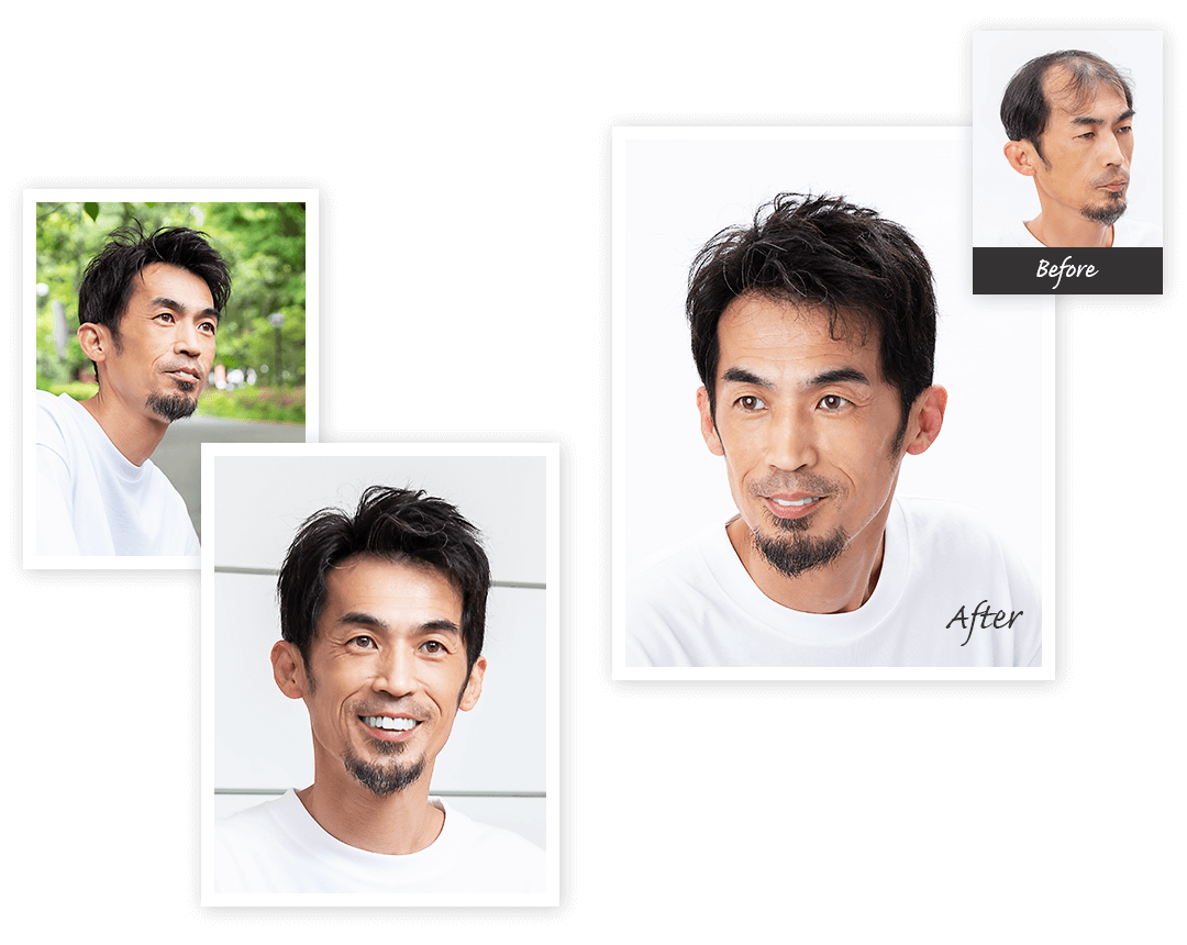 Aderans 假发 案例1