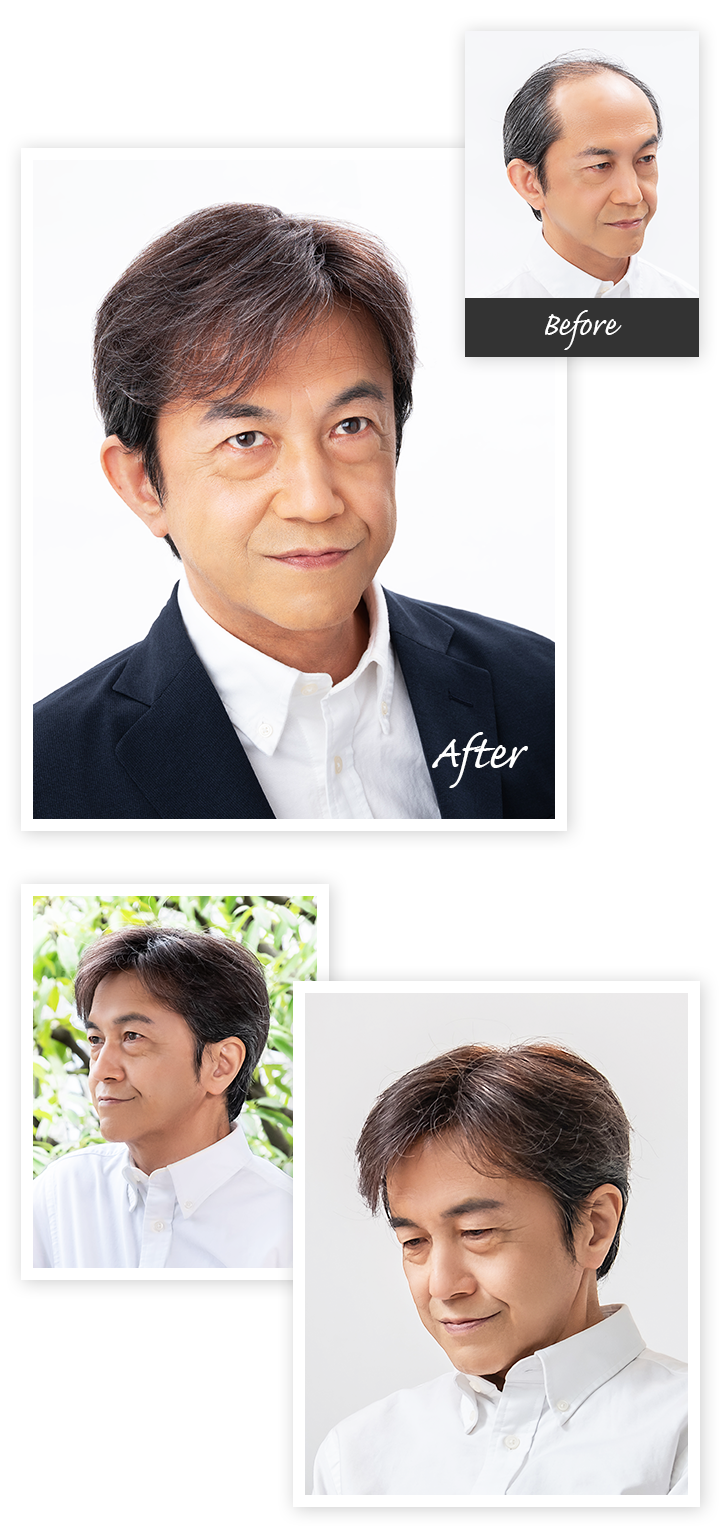 Aderans 假发 案例2