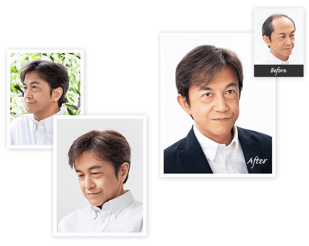 Aderans 假发 案例2