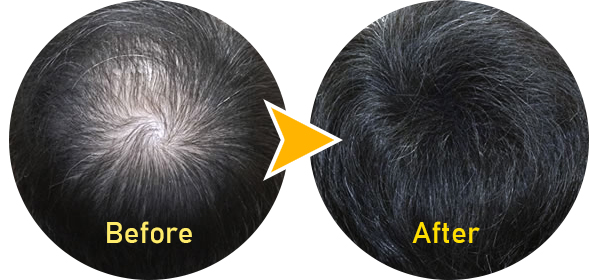 HairPlus SpeedE Premium Befor&After