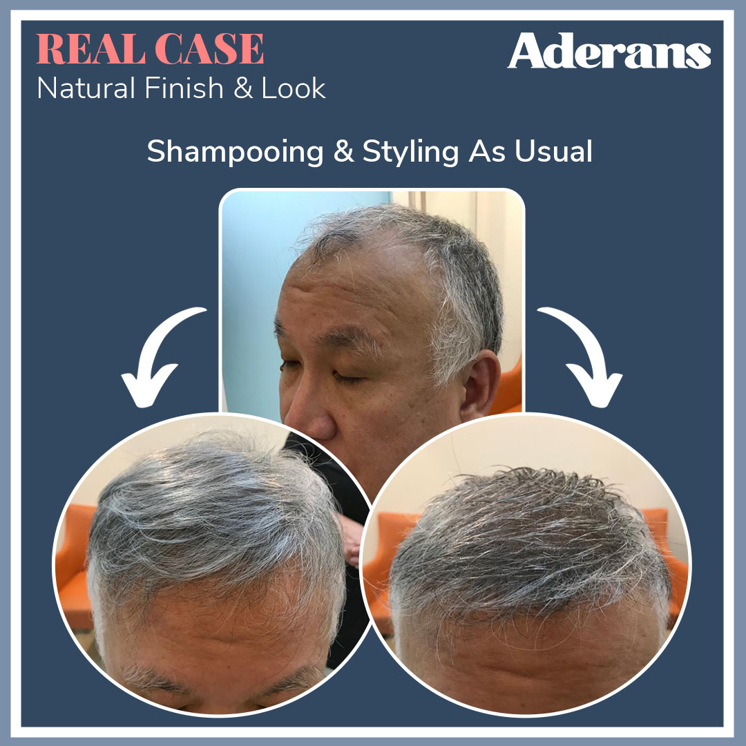 Bespoke Hair Replacement System for Men | Aderans Singapore Official Site